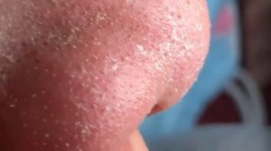 Огромные Прыщи _ Релакс акне _ Выдавливание прыщей _ Черная точка #Прыщи