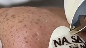 Огромные прыщи _ Релакс с акне _ Выдавливание прыщей _ Черная точка #Прыщи