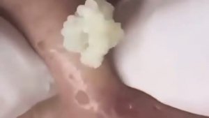 Выдавливание угрей.  #комедоны #проблемнаякожа #уходзалицом