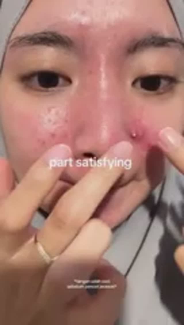 Лучшая подборка видео: Выдавливание прыщей, кист, удаление черных точек и дезинфекция Ч 23