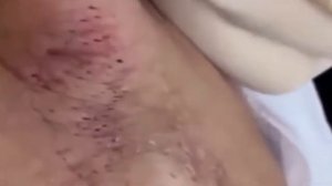 Прыщи _ Огромные прыщи _ Релакс с акне _ Выдавливание прыщей _ Черная точка #Прыщи_2