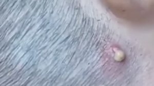 Чёрные точки _ Огромные прыщи _ Релакс с акне _ Выдавливание прыщей _ #Прыщи