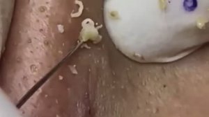 Прыщи _ Огромные прыщи _ Релакс с акне _ Выдавливание прыщей _ Черная точка #Прыщи_9