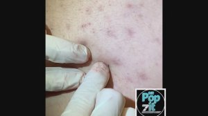 Множественное удаление чёрных точек. Мощное выдавливание. Вскрытие кисты. #черныеточки #киста