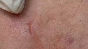 Сложный случай лечения угревой болезни. #тяжелоеакне #лечениеакне #угреваяболезнь