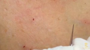 Акне в зрелом возрасте. Часть 2 #акнеувзрослых #возростнаякожа #гормональныепрыщи