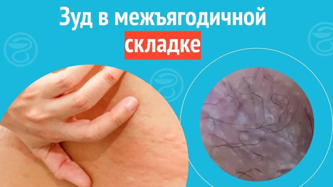 😦 Зуд в межъягодичной складке. Клинический случай №1463