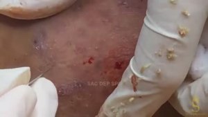 Все виды акне на лице: детальный разбор одного случая за 30+ минут.