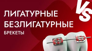 ✨ Лигатурные vs безлигатурные брекеты: как ухаживать за ними правильно?