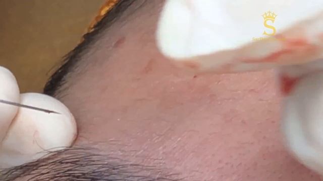 Простое извлечение подкожных прыщей. #скрытыепрыщи #удалениемилиумов #легкаяэкстракция #чисткалица