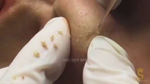 Полная очистка носа от черных точек #чистканоса #удалениечерныхточек #черныеточки #экстракция