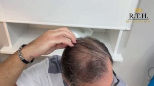 Пересадка волос — это навсегда?