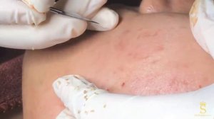 Огромный прыщ на мочке уха + воспаленный прыщ #прыщнаухе #огромныйпрыщ #воспаленныйпрыщ