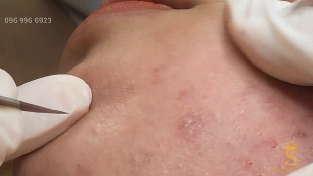 Спасение проблемной кожи: путь к восстановлению. #лечениеакне #спасениекожи #уходзалицом