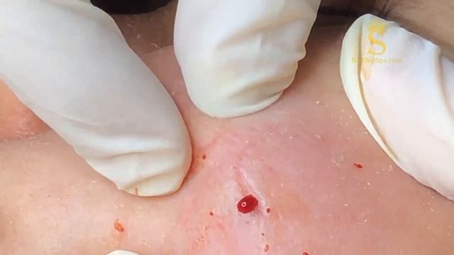 Прыщи, которые так и хочется выдавить. Невероятно приятно смотреть! #поппинг #созревшийпрыщ