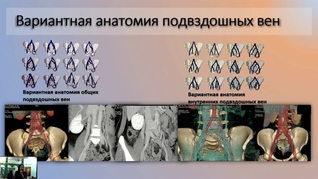 Идрисова Р. М. КТ флебография в диагностике компрессионных синдромов при варикоцеле