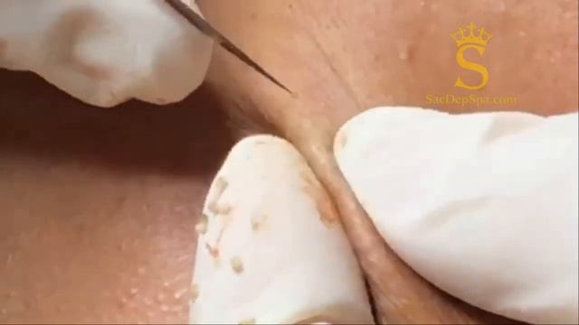 Смотрите, настоящий «хит» — созревшие чёрные точки! #черныеточки #зрелыечерныеточки