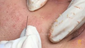 Очистка скрытых прыщей, белых угрей (закрытых комедонов) #удалениебелыхугрей #комедоны #чисткалица