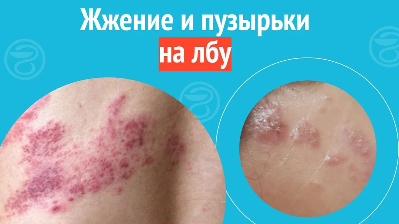 🫧 Жжение и пузырьки на лбу. Клинический случай №1465