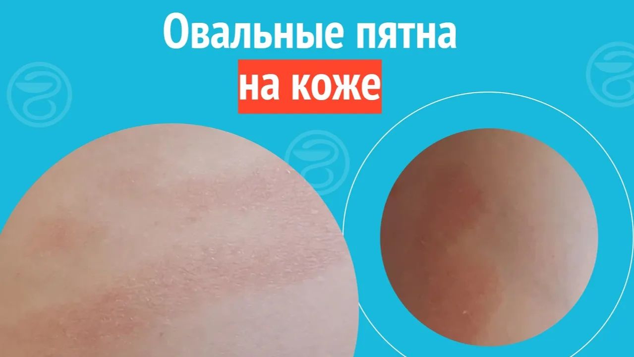 ⏺️ Овальные пятна на коже. Клинический случай №1446