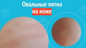 ⏺️ Овальные пятна на коже. Клинический случай №1446
