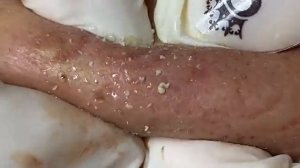 Удивительное удаление белых и чёрных угрей. Часть 2 #белыеугри #черныеточки