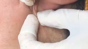 Подборка: прыщи в ушах. #прыщивушах #чисткаушей #удовлетворение #экстракция