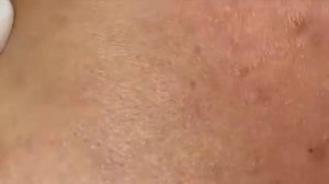 Чистка лица от угрей для девушки #удалениеугрей #чисткалица #черныеточки #белыеугри