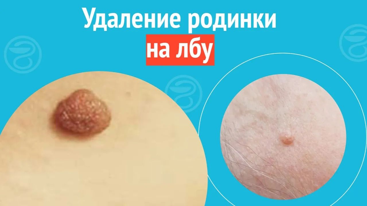 👉 Удаление родинки на лбу. Клинический случай №1454