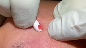 Продолжение экстракции акне. Еще больше удалений. Отличные улучшения. Инъекции.