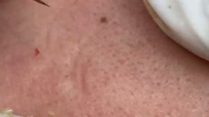 Лечение акне для чувствительной кожи. #чувствительнаякожа #лечениеакне