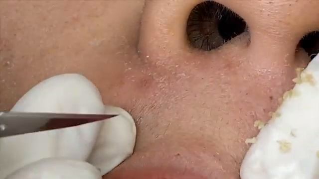 Лечение прыщей, скрытых под кожей. #лечениеподкожныхпрыщей #скрытоеакне смотреть онлайн