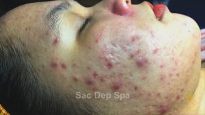 Спасение проблемной кожи: путь к восстановлению. #лечениеакне #спасениекожи #уходзалицом