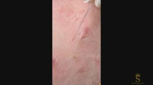 Гладкая кожа? Не тут-то было! Столько скрытых прыщей! #скрытыепрыщи #подкожныепрыщи #чисткалица