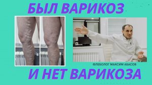 Варикоз ног до и после лазерной операции. ЭВЛК. Флеболог Москва.