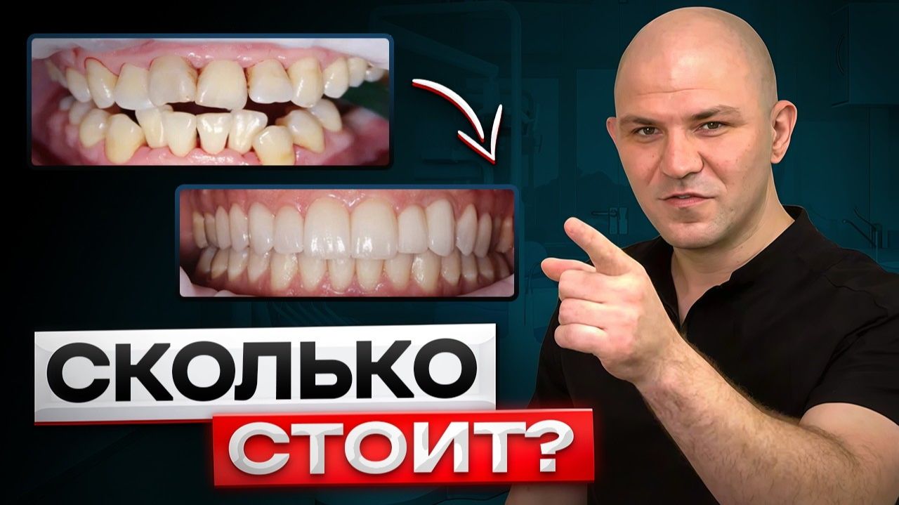 Виниры За Которые Мне Не Заплатили! Сколько Стоит Идеальная Улыбка? Цены на Стоматологию 2026