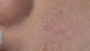 Выдавливание чёрных точек без кровотечения. #деликатнаяэкстракция #удалениечерныхточек