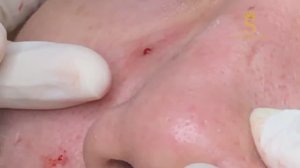 Простое извлечение подкожных прыщей. #скрытыепрыщи #удалениемилиумов #легкаяэкстракция #чисткалица