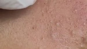 Чёрные и белые точки. Удаление. #черныеточки #белыеугри #комедоны #чисткалица