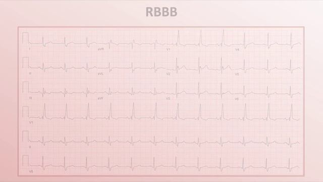 07 Intro to EKG Interpretation - Bundle Branch Blocks Eric Strong
