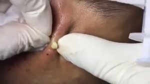 Удаление тяжелых форм акне. Лечение кистозных прыщей. #лечениеакне #кистозныепрыщи #тяжелоеакне