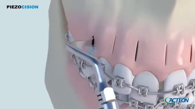 Piezotome Solo LED  Piezocision