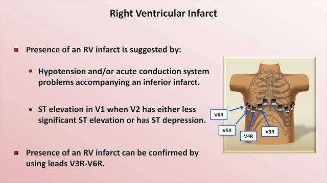 15 Intro to EKG Interpretation - Myocardial Infarctions (Part 2 of 2)  Eric Strong