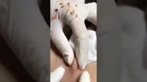 Супер-удаление любых видов прыщей. #удалениепрыщей #профессиональнаячистка