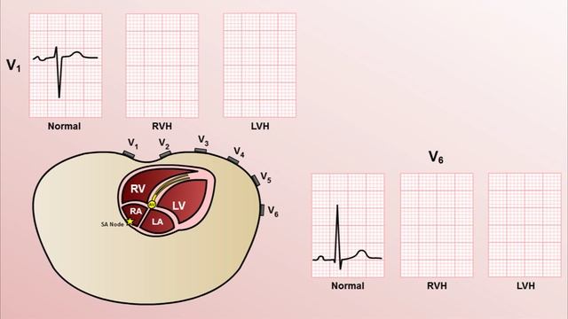 06 Intro to EKG Interpretation - Chamber Enlargement Eric Strong