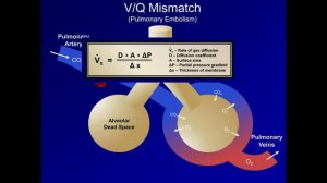 18_Hypoxemia- Mechanisms and Etiologies (Understanding ABGs - Lecture 18)
