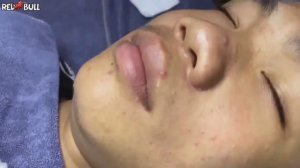 Глубокое очищение от прыщей. Антистресс-процедура для мгновенного облегчения кожи #𝟗𝟎𝟎𝟑𝟔𝟕