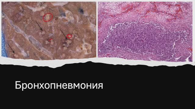 Острое воспаление - Часть 2. (Блок 3. Лекция 3)