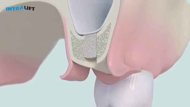 Piezotome Solo LED  Intralift 2