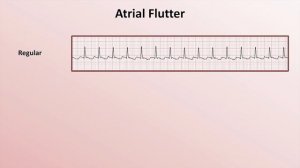 09 Intro to EKG Interpretation - Overview of Tachyarrhythmias